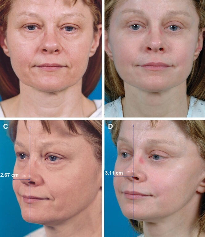Beauty Space Clinic Женщина в 51 год до и после СМАС и круговой блефаропластики