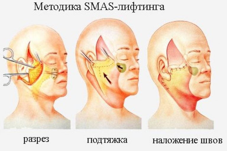 Методика SMAS-лифтинга Клиника Бьюти Спейс