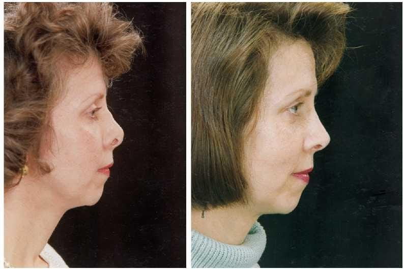 Пациент до и после ринопластики